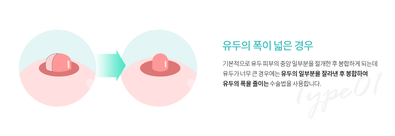유두의 폭이 큰 경우