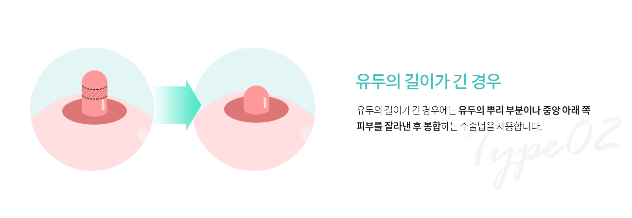 유두의 길이가 긴 경우