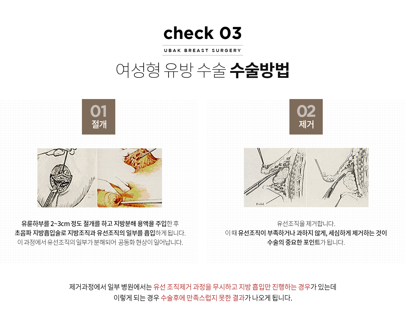 여성형유방 수술방법