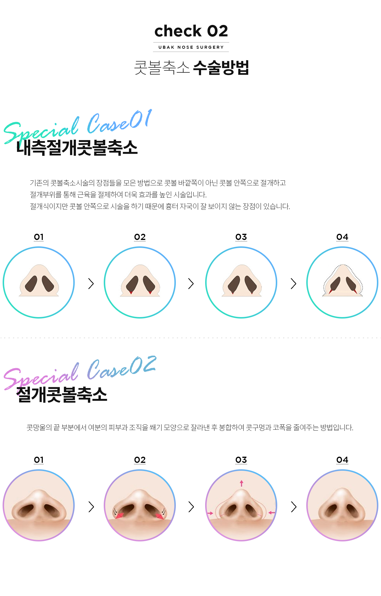 콧볼축소 수술방법