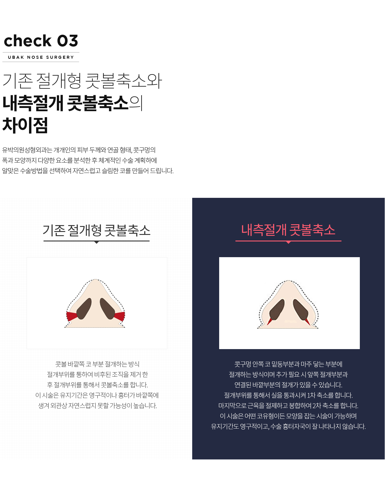 기존 절개형 콧볼축소와 내측절개 콧볼축소의 차이점