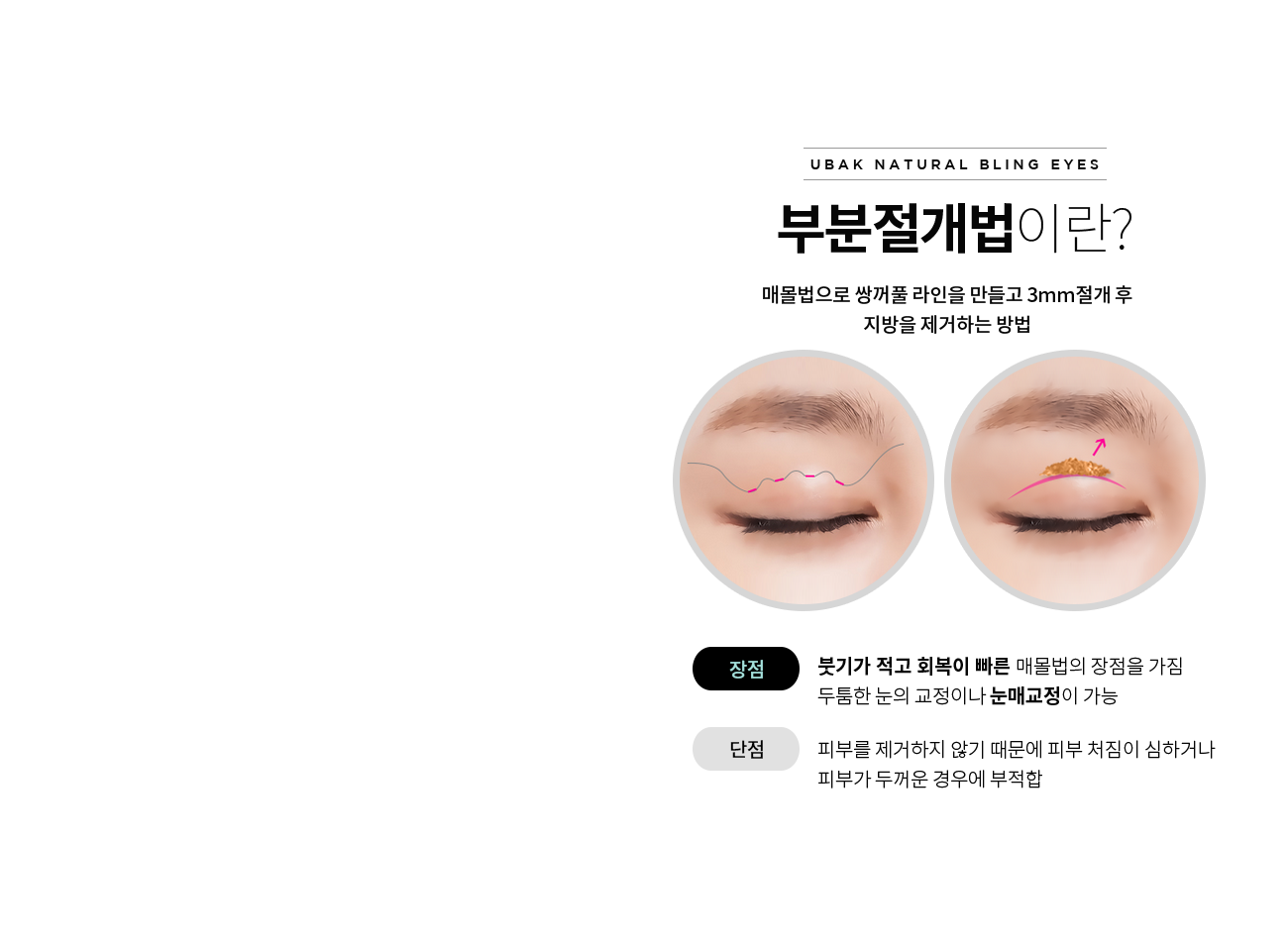 부분절개법