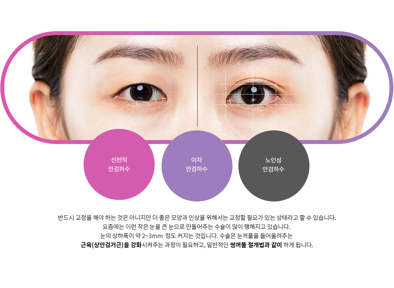 눈매교정수술
