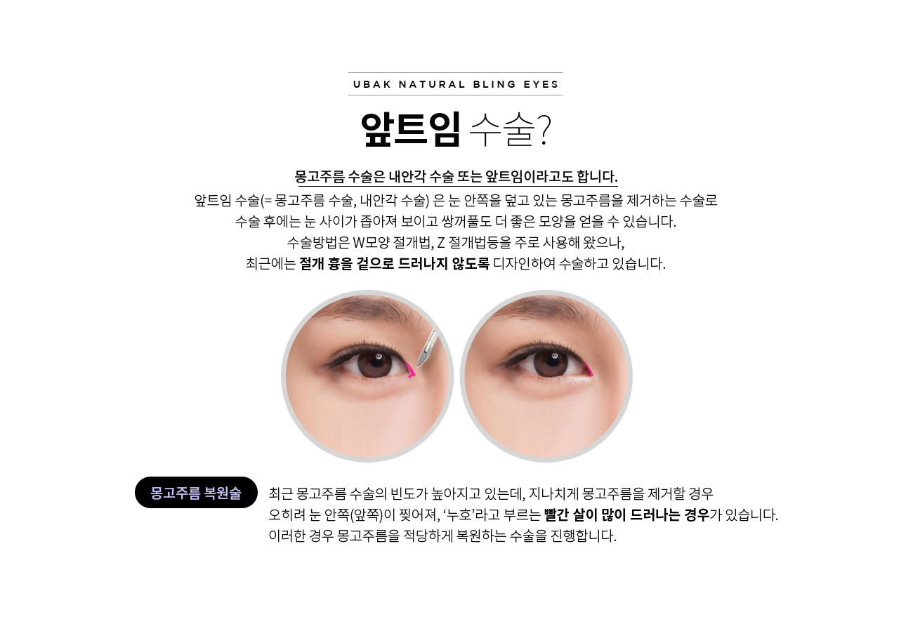 앞트임