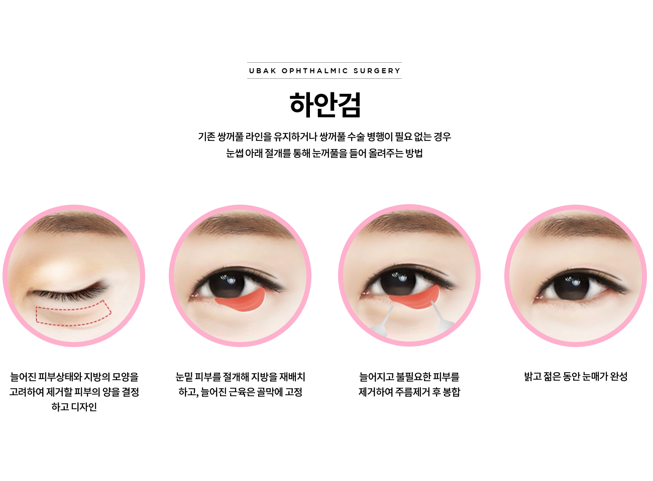하안검