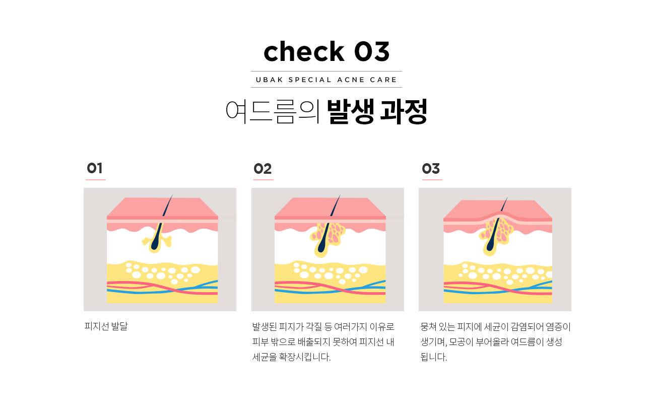 여드름의 발생과정