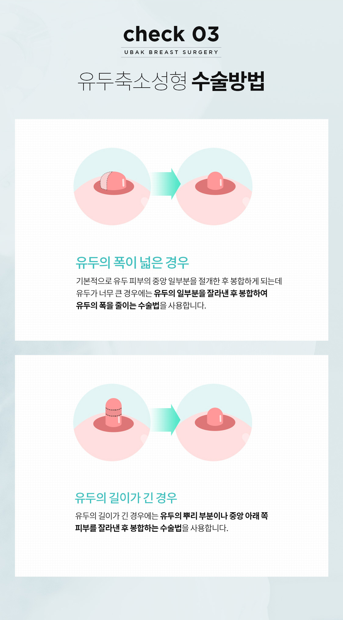 유두축소성형 수술방법